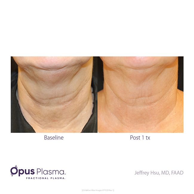 Opus-Before-After-Web-2.jpg